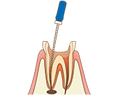 歯の神経の治療