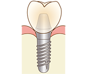 インプラント治療